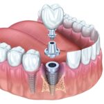 full mouth dental implant mohali