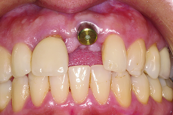 What is Abutment in Dental Implant?